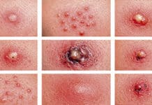 ¡Haz clic y conoce las picaduras de insectos más comunes!